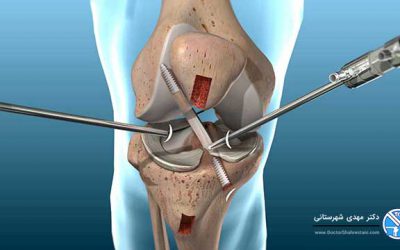 عمل جراحی رباط صلیبی، علت پارگی، مراقبت ها، عوارض و هزینه عمل