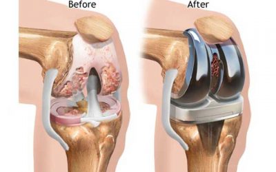 تعویض مفصل زانو، هزینه، عوارض و نحوه عمل جراحی