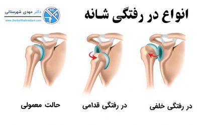 جراحی دررفتگی مکرر شانه