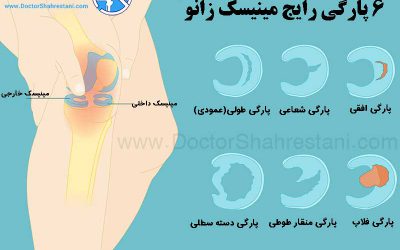 جراحی ترمیم مینیسک زانو، علت پارگی و هزینه و عوارض عمل