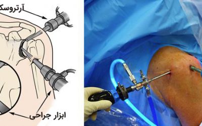 آرتروسکوپی شانه، فیزیوتراپی و مراقبتهای بعد از عمل و هزینه عمل