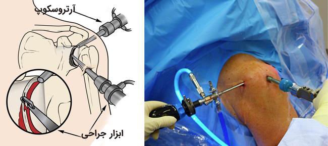 آرتروسکوپی شانه، فیزیوتراپی و مراقبتهای بعد از عمل و هزینه عمل