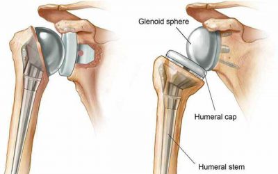 تعویض مفصل شانه