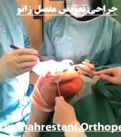 فیلم واقعی جراحی تعویض مفصل زانو توسط دکتر شهرستانی