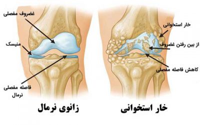 آرتریت زانو، علائم، درمان و هزینه جراحی