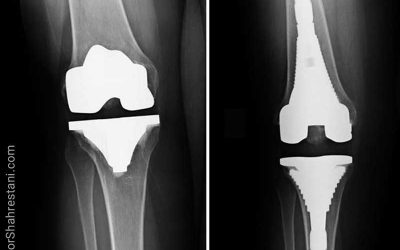 جراحی مجدد تعویض کامل مفصل زانو