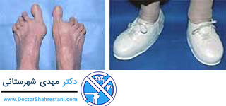 پاهای مبتلا به آرتریت روماتوئید و کفش های مورد استفاده برای درمان آرتریت روماتوئید