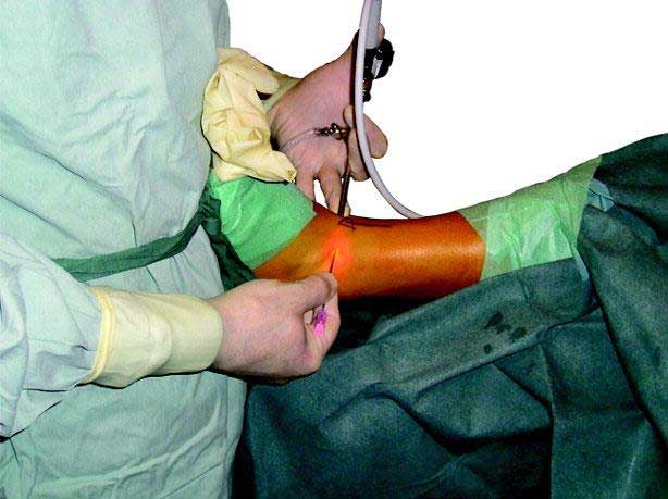 پزشک جراح درحال استفاده از آرتروسکوپ