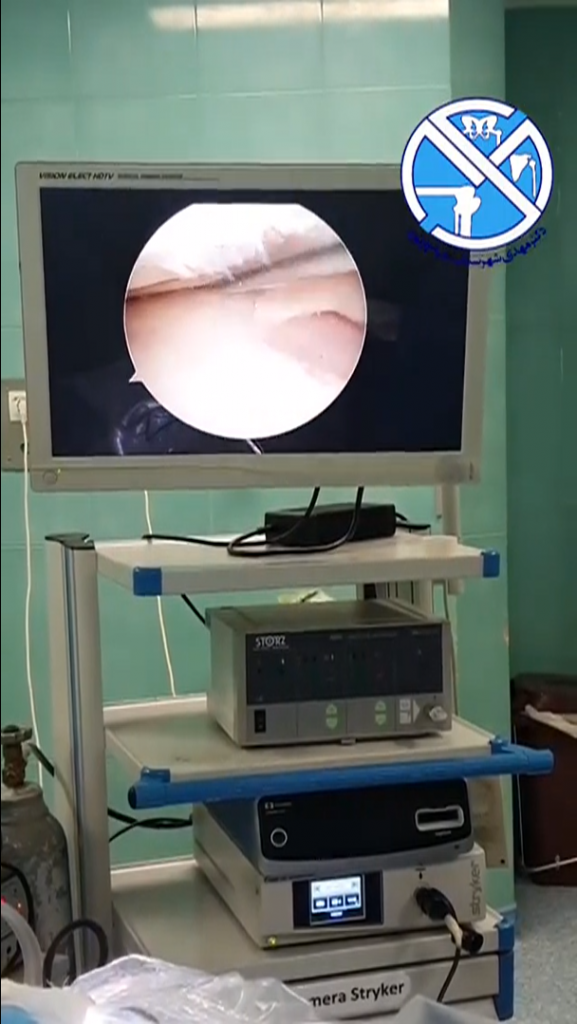 آرتروسکوپی زانو حین جراحی استئوتومی