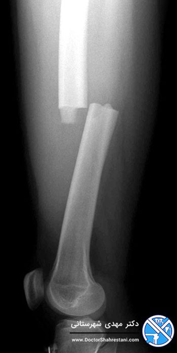 عکس رادیولوژی شکستگی عرضی استخوان ران