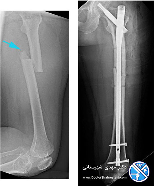 عکس رادیولوژی از چسباندن شکستگی استخوان ران با پیچ