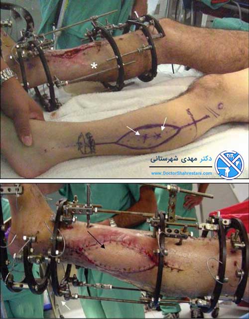 استفاده از فیکساتور برای شکستگی پا