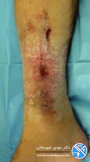 عفونت پا بعد از شکستگی