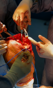 لوزبادی در زانو و برداشتنش هنگام جراحی تعویض مفصل زانو